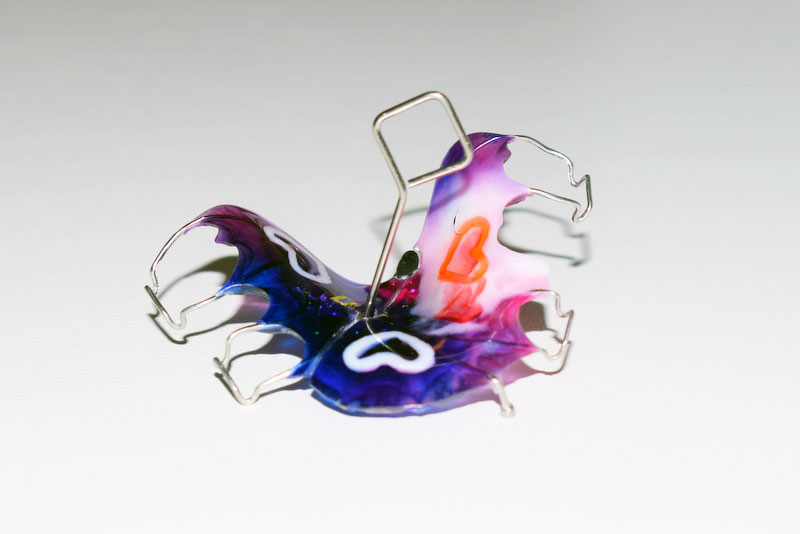 Treatment of malocclusion with a removable appliance with a screw