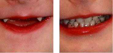 Child after primary tooth loss and with a pediatric denture