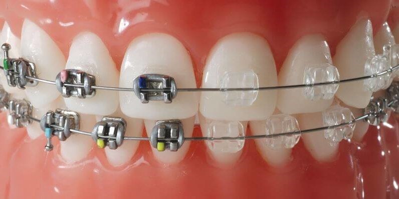 Konstrukcja stałego aparatu ortodontycznego