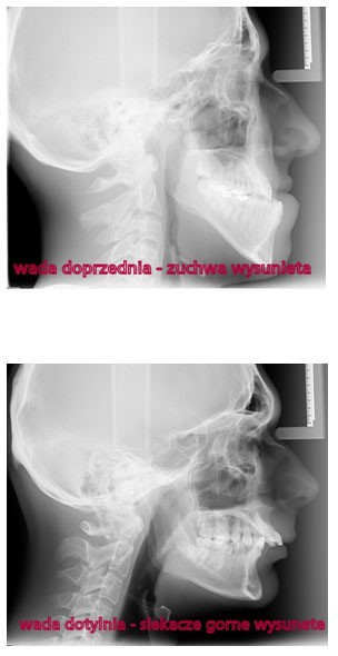 Zdjęcie cefalometryczne