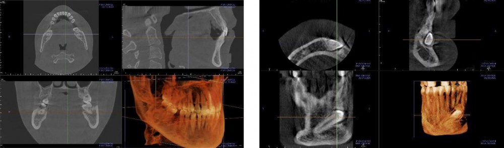 Skan szczęki - tomograf