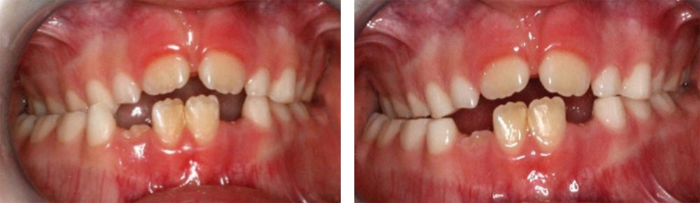 Grinding of primary teeth