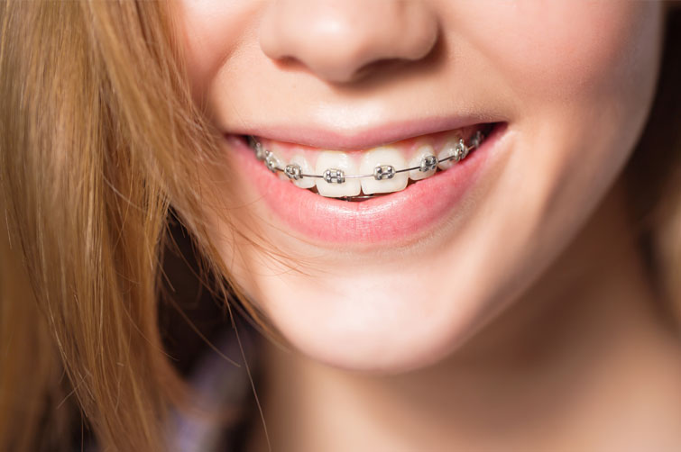 Zalety aparatu stałego