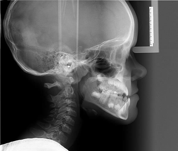 Zdjęcia cefalometryczne