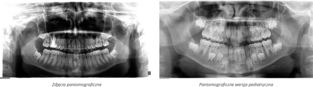 Zdjęcia pantomograficzne