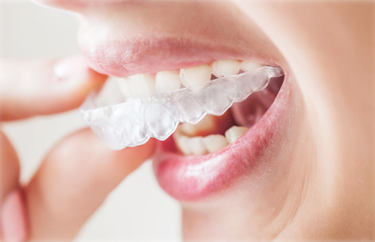 Retencje i aparaty retencyjne