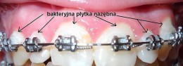 Bakteryjna płytka na zębach