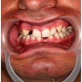 Przykład wady zgryzu