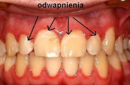Odwapnienia