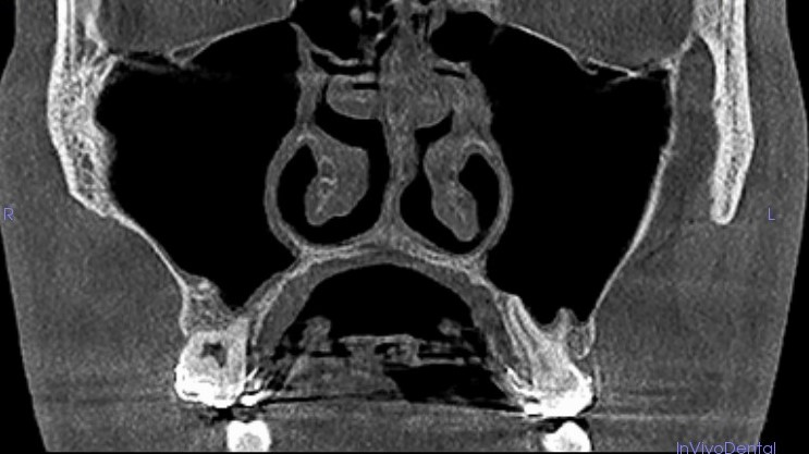 Pacjent po ekspansji szczęki