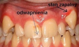Stan zapalny i odwapnienia na zębach