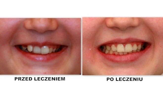 efekty zabiegu ortodontycznego 10