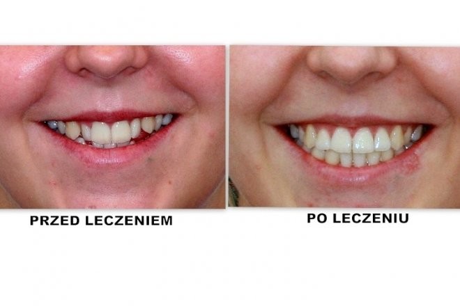 efekty zabiegu ortodontycznego 11