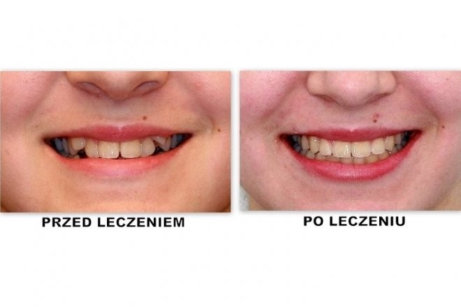 efekty zabiegu ortodontycznego 12