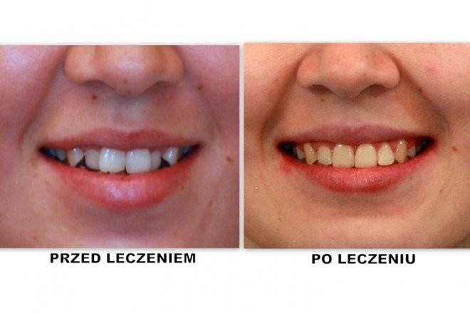 efekty zabiegu ortodontycznego 13