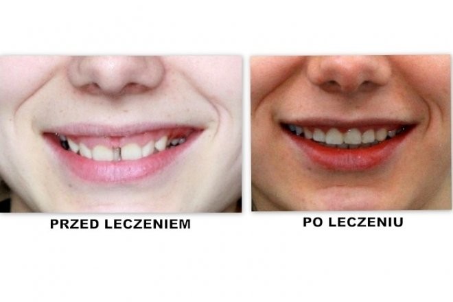 efekty zabiegu ortodontycznego 2