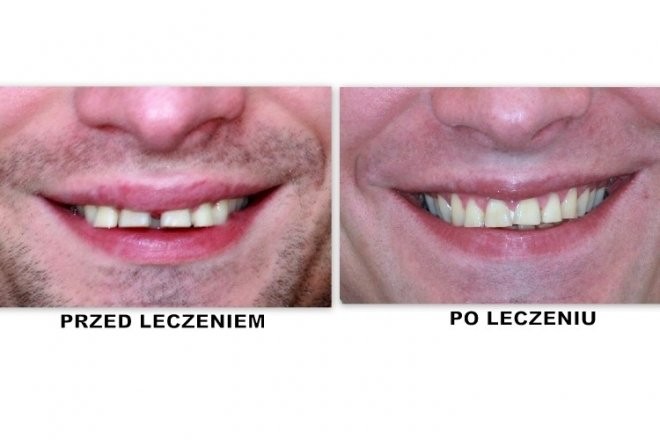 efekty zabiegu ortodontycznego 3