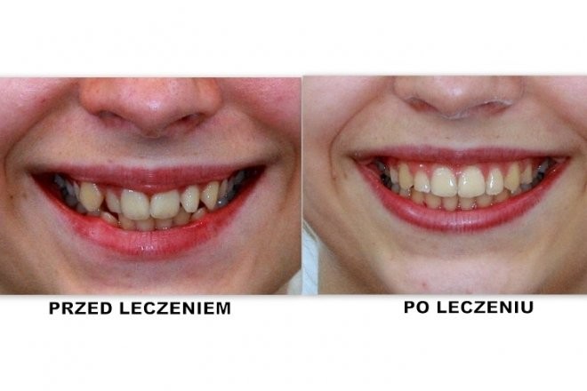 efekty zabiegu ortodontycznego 4