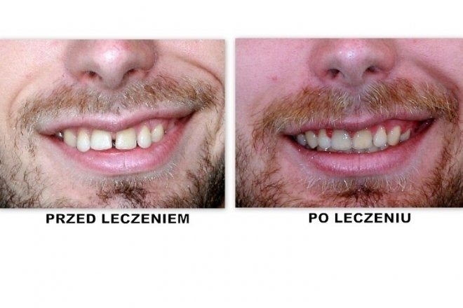 efekty zabiegu ortodontycznego 6