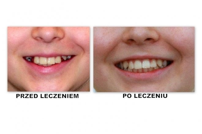 efekty zabiegu ortodontycznego 7