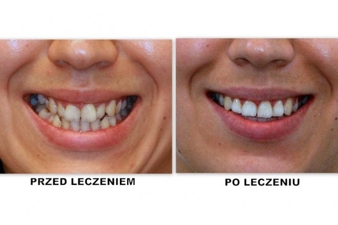 efekty zabiegu ortodontycznego 8