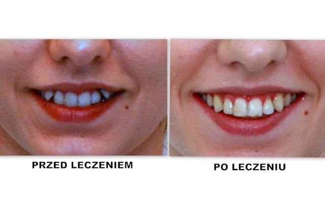 efekty zabiegu ortodontycznego 9