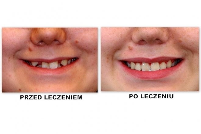 efekty zabiegu ortodontycznego4